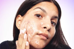 Understanding Acne Prevention to Add to Your Routine