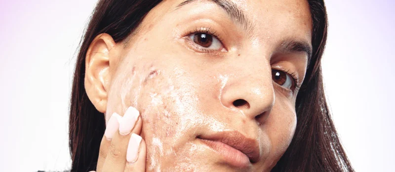 Understanding Acne Prevention to Add to Your Routine