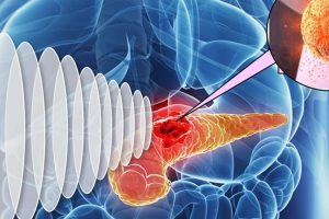 How Early Cancer Detection Saves Time: A Step-by-Step Approach