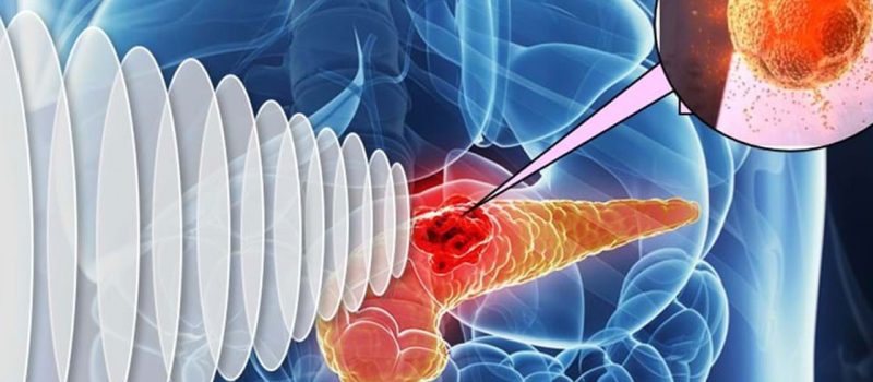 How Early Cancer Detection Saves Time: A Step-by-Step Approach