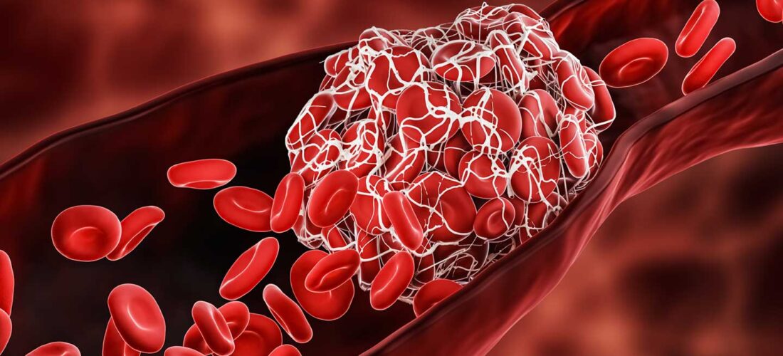Blood Clot Disorders: Diagnosis and Long-Term Treatment Strategies